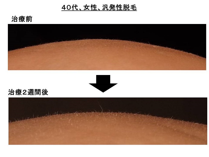 円形脱毛症　病院""